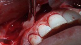 perio esthetic surgery Esthetic crown lengthening_16