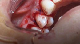 جراحی افزایش طول و طراحی لبخند - اردیبهشت ۹۷