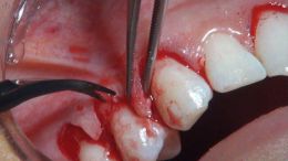 perio esthetic surgery Esthetic crown lengthening_19