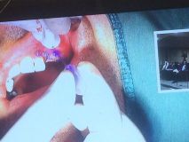 Implant and GBR course in Hamedan_15