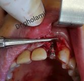 SPI system presentation with live surgery_10