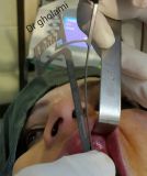 معرفی سیستم SPI همراه با جراحی زنده و Immediate Loading - آبان ۹۵