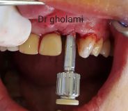 SPI system presentation with live surgery_12