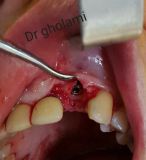 SPI system presentation with live surgery_17