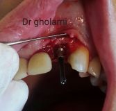 SPI system presentation with live surgery_20