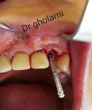 معرفی سیستم SPI همراه با جراحی زنده و Immediate Loading - آبان ۹۵